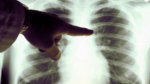 SİGARA AKCİĞER KANSERİ RİSKİNİ 20 KAT ARTIRIYOR