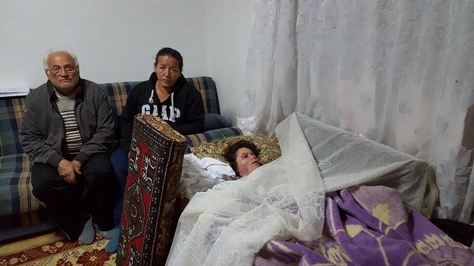 Kocasının Kezzapla Yaktığı Genç Kadın’a Yapay Göz Takıldı