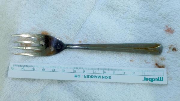 Yuttuğu Çatal, Ameliyatla Midesinden Çıkarıldı