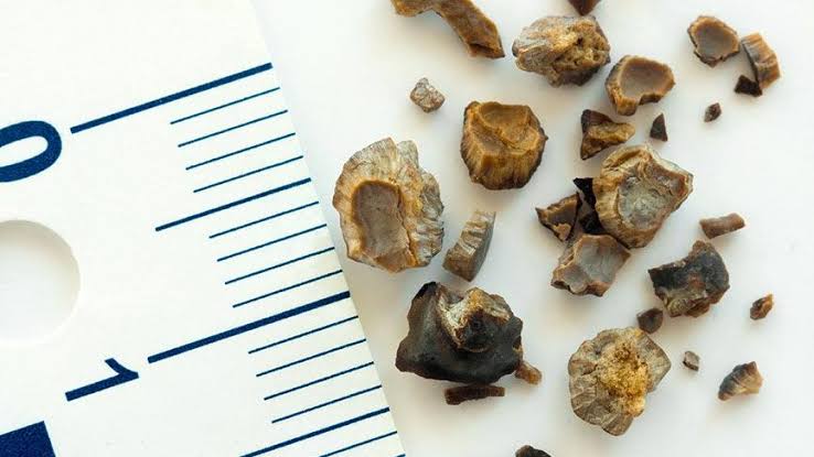 Taş Hastalığı nedir?