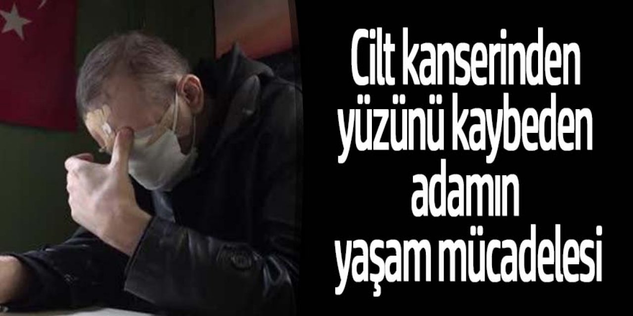 Cilt kanserinden yüzünü kaybeden adamın yaşam mücadelesi