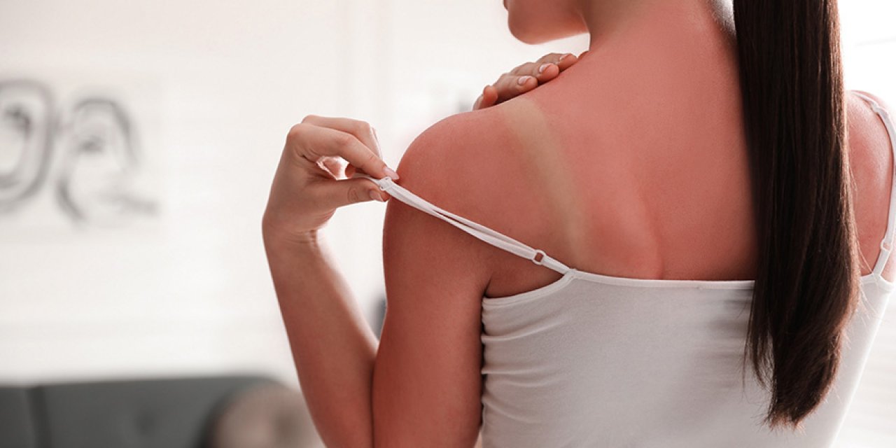 Dikkat! Cildiniz iyileşinceye dek asla… Cildinize bu ürünleri sakın sürmeyin!