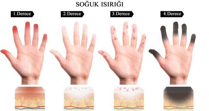 soguk-isirmasi-nedir-nelere-dikkat-edilmeli.jpg